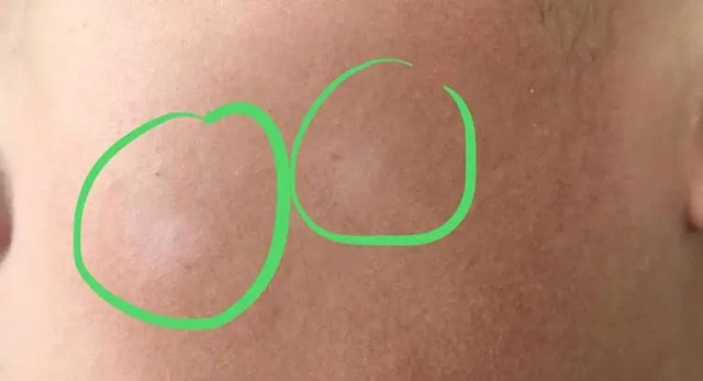 孩子脸上有白斑什么原因造成的