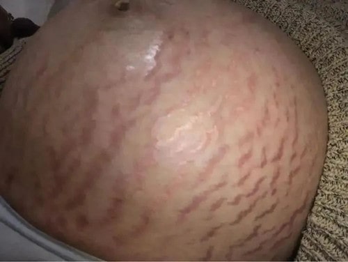 同样是怀胎十月，为什么有的妈妈就没有妊娠纹？