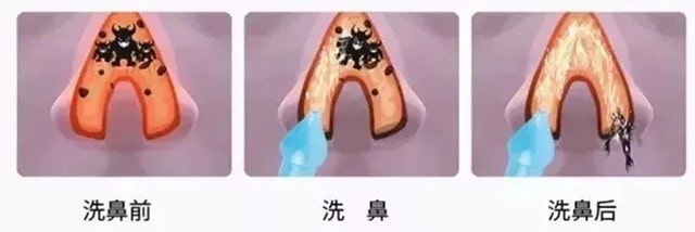 宝宝鼻塞流鼻涕如何护理？