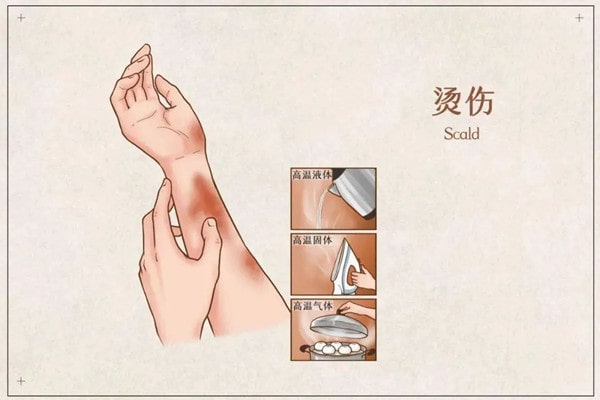 孩子被烫伤后正确的处理方法
