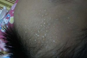 小孩子头皮特别会出汗是什么原因