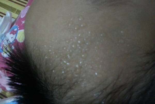 小孩子头皮特别会出汗是什么原因