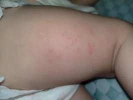 宝宝蛋白过敏什么症状