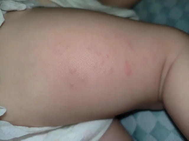 宝宝蛋白过敏什么症状